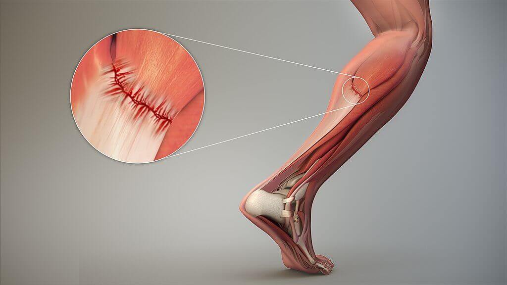 Muscle damage 3d image